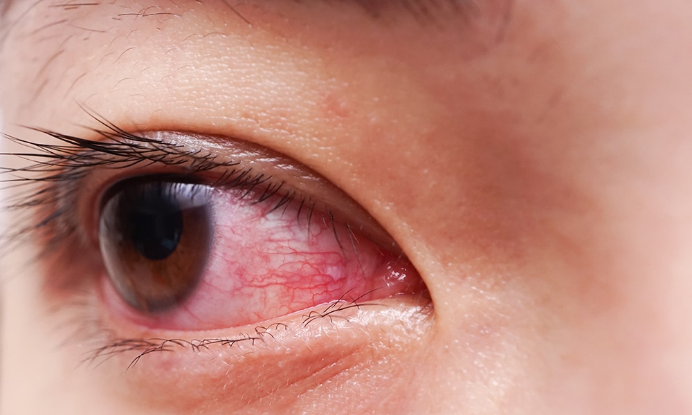 Comment diagnostiquer une allergie oculaire devant un œil rouge ...