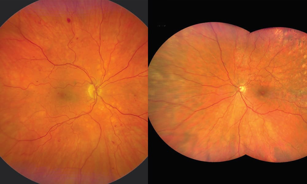 Exploration De La Périphérie Rétinienne En Ultra Grand Champ - 