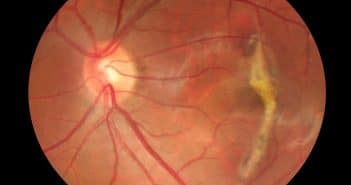Quel anti-VEGF pour les néovaisseaux de type III de la DMLA ?