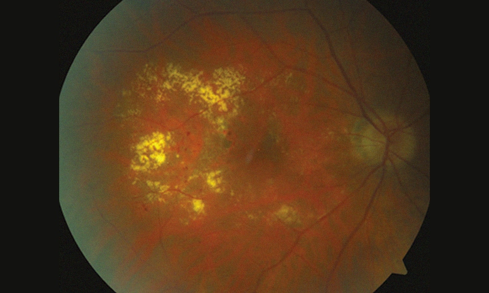 Télangiectasies : diagnostic et avancées thérapeutiques - Réalités ...