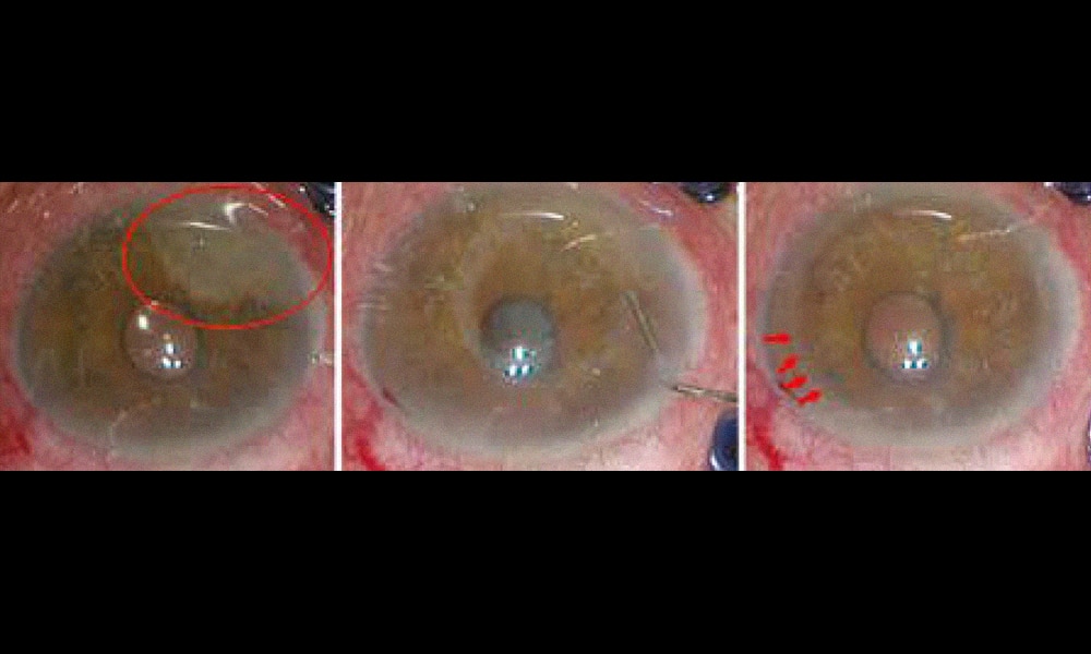 F4H5 : un dissolvant pour résidus d'huile de silicone intraoculaires -  Réalités Ophtalmologiques