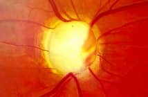 Vieillissement de la voie trabéculaire et glaucome