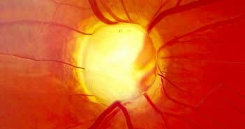 Vieillissement de la voie trabéculaire et glaucome