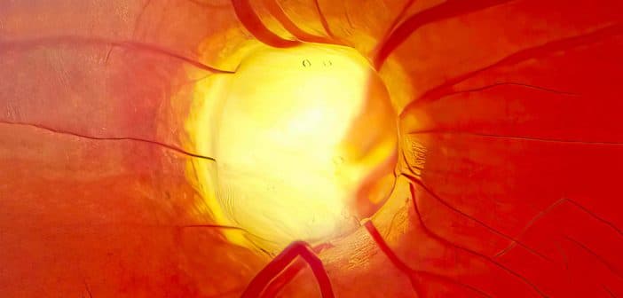 Vieillissement de la voie trabéculaire et glaucome