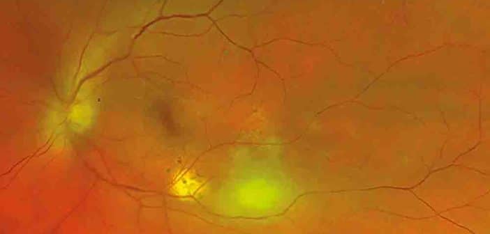 Foyer choriorétinien toxoplasmique situé au pôle postérieur. Présence d’une cicatrice atrophique péri-lésionnelle.