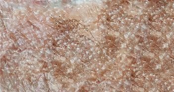 Glaucome évolutif : quelle place réelle pour la neuroprotection en 2026 ?
