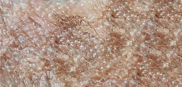 Glaucome évolutif : quelle place réelle pour la neuroprotection en 2026 ?